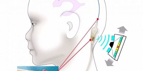 Prueban con "éxito" una tecnología que previene obstrucciones en implantes de pacientes con hidrocefalia